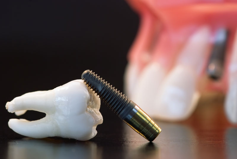 Consider dental implants as a permanent solution for missing teeth. Learn more about the procedure from our experienced team.